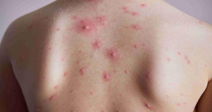 suspected monkey pox case in haridwar but found chicken pox by health department